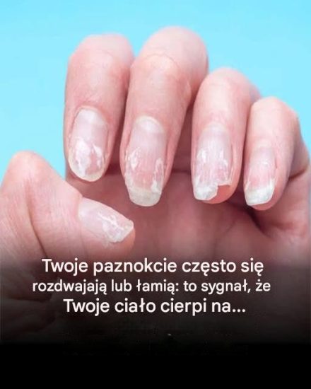 Twoje paznokcie łamią się lub rozdwajają: ten szczegół wskazuje na problem… Zobacz więcej
