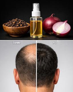 Niesamowite korzyści goździków i łupin cebuli dla wzrostu włosów